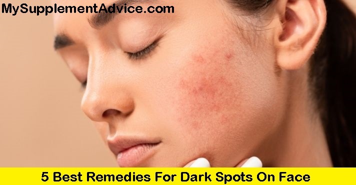 5 Best Remedies For Dark Spots On Face (2024)