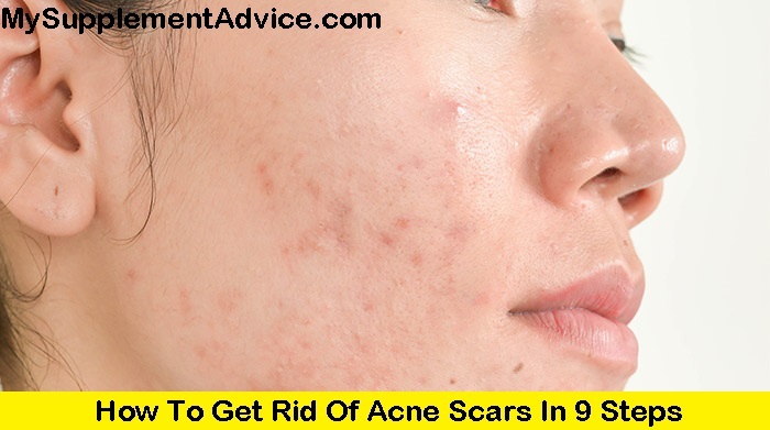 How To Get Rid Of Acne Scars In 9 Steps (2022)
