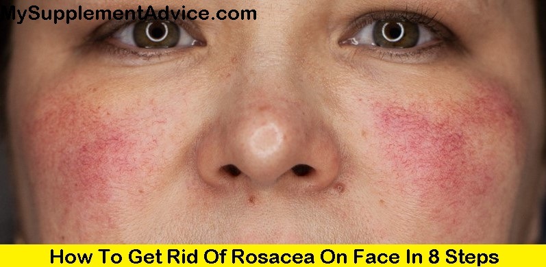 How To Get Rid Of Rosacea On Face In 8 Steps (2022)