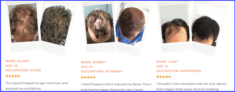 My Review: Happy Head - Best Male Hair Loss Treatment?