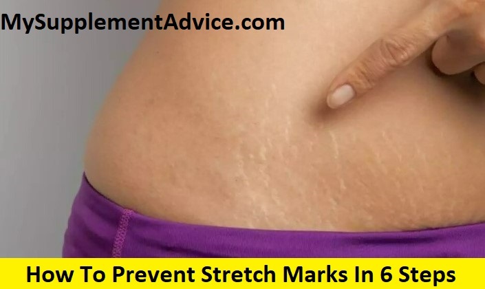 How To Prevent Stretch Marks In 6 Steps (2022)