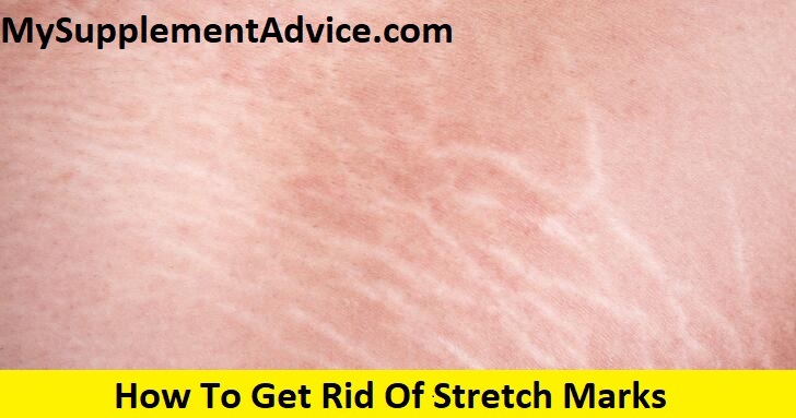 How To Get Rid Of Stretch Marks In 9 Steps (2022)
